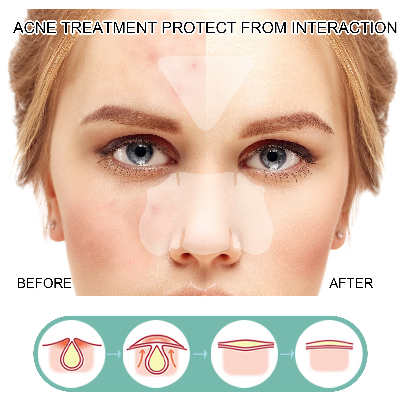 Acne Removing Patch To Fade And Remove Acne