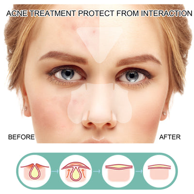 Acne Removing Patch To Fade And Remove Acne